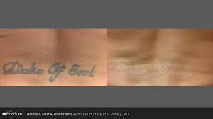 How does preauthorization affect the procedure? Laser Tattoo Removal Imperial Valley And Yuma El Centro Dermatology