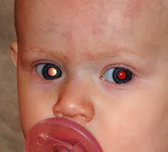 Symptoms of eye cancer can include: Signs And Symptoms Of Retinoblastoma We C Hope