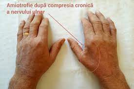 At furniture.mu, we tried something different…and it works! Furnicaturi Si Amorteli In Maini Si Degete Tratament Dr Vladislav Gyebnar