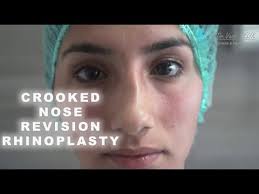 Crooked Nose Revision Rhinoplasty