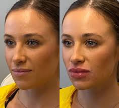 Find a reputable deal on botox near you. Lip Flip Vs Lip Filler Which Is Right For Me Boss Gal Beauty Bar