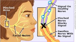 In most cases, the weakness is temporary and significantly improves over weeks. A To Z Bell S Palsy For Parents Nemours