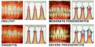 Boala Parodontala Cum O Recunoastem Citysmile