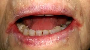 When drooling is represented as a dip in the outline of the mouth, rather than as actual saliva leaking from the mouth. Angular Cheilitis Wikipedia