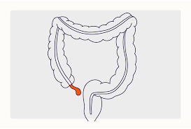 Image result for Appendicitis