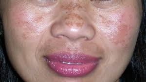 What Are Blemishes And How Can You Get Rid Of Them
