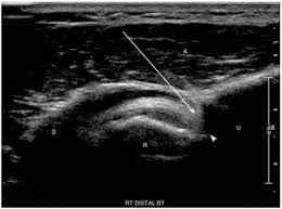 Image result for Biceps Tendon Injection