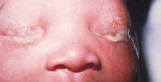 Image result for Gonococcal Conjunctivitis