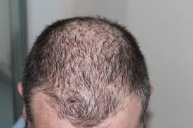Iodine detoxes bromine, a very common toxin which the human body naturally detoxes through hair. Effective Ways To Tackle Male Pattern Baldness New Age Man