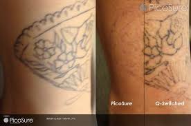 Laser tattoo removal has never looked so good! Laser Tattoo Removal Before After Photo Gallery