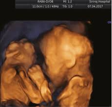 We did not find results for: Additional Benefits Of Three Dimensional Ultrasound For Prenatal Assessment Of Twins