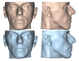 Analysis and comparison of quality of life and patients' satisfaction  between dental-skeletal dysmorphisms and Obstructive Sle