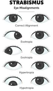 Image result for Strabismus