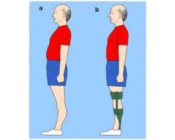 Related online courses on physioplus. Causes And Management Of Hyperextension Of Knee In Hemiplegic And Paraplegic Gb School Of Neuro Rehab Aquatic Therapy