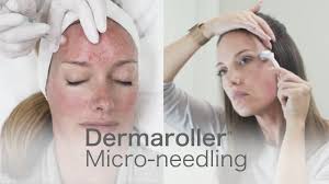Dermarollerclinics Com Edermastamp And The Home Care Product Line By Dermaroller Youtube Skinmedix xl micro needle roller 1.5 mm for body. dermarollerclinics com edermastamp and the home care product line by dermaroller