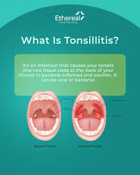Image result for Tonsillitis