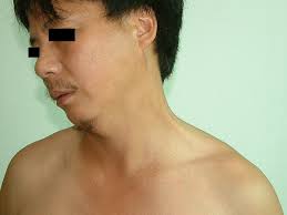 Image result for Webbed Neck