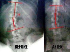 20 Scoliosis Correction Center Ideas Scoliosis Correction Alternative Treatments