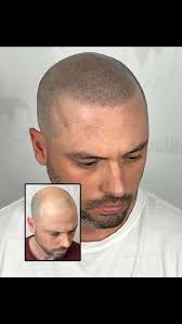 Bring back your confidence with SCALP MICROPIGMENTATION 💉 Instant, natural  & long-lasting results... A quick, effective solution ! NO surgery & NO  complicated maintenance... Choose your look: Natural hairline Modern