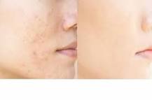 Image result for what is genesis skin treatment