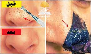 ماسك الرؤوس السوداء ٩ طرق تنهيها فورا ثقف نفسك