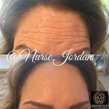 Cancellations · botox's profile picture. Botox Before After Aesthetica Swansea Facial Aesthetics