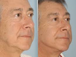 60 Year Old Male Facelift Facelift Drpaulblair Wv Facelift Facelift Before And After Sagging Skin