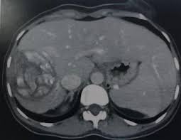 After 3 months usg was done which showed no liver hydatid cyst. The Surgical Management Of Hydatid Cyst Of The Liver What Is New Intechopen