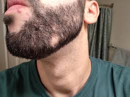 Unwanted facial hair can be an embarrassing concern for women, and can sometimes even cause home remedies can help to remove facial hair permanently. Please Help I Have Holes In My Beard Malegrooming