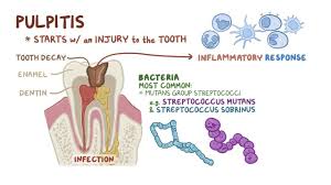 Image result for Pulpitis