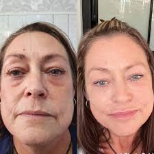 Ace Beauty Clinic Advanced Aesthetics 2, Wood street Arnold Nottingham NG5  7DY. Turning back time with the 8 point lift using filler ❤️ Dm me to book  or head over to my