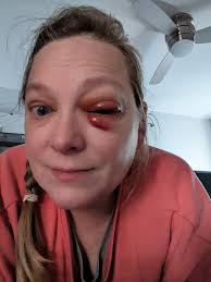 Hi my moonies @todos. It's been a while. I decided to pass by to let you  know over the progress of my recuperation that hasn't been easy, but I  think I should