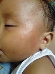 Morng guyz I need ur prayers,I got alergy since ystrday