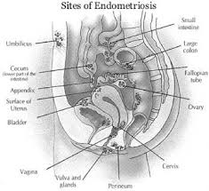 Pin On Endometriosis