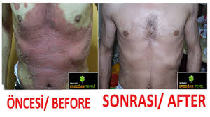 Kil Koku Iltihabi Tedavisi Bitkisel Hidradenitis Suppurativa Hs Kopek Memesi Youtube