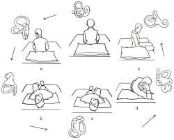 Turn whole body to right, head facing towards floor for 1 minute 4. Frontiers Self Treatment Of Posterior Canal Benign Paroxysmal Positional Vertigo A Preliminary Study Medicine