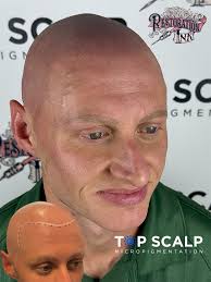 Top Scalp Micropigmentation @ Restoration Ink