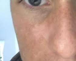 This is due to the fact that ultraviolet leads to a deterioration in the production of melanin. White Patches On Face Help Uk Muscle Co Uk Forum