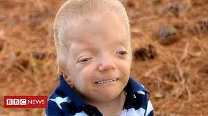A Mae Que Luta Contra Memes Que Usam Fotos De Seu Filho De 3 Anos Com Doenca Terminal Bbc News Brasil
