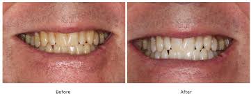 How much does zoom whitening cost. How Much Is Teeth Whitening At A Dentist Teethwalls