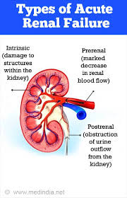 Chronic kidney disease, also known as chronic renal failure, chronic renal disease, or chronic kidney failure, is much more widespread than people realize; Acute Renal Kidney Failure Causes Symptoms Diagnosis Treatment And Complications