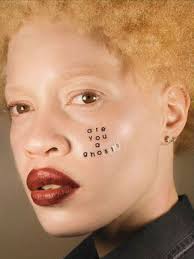 Portrait Series Highlights Beauty of Albinism, Birthmarks & Other Skin  Conditions, Marci Robbins, June 18, 2018.