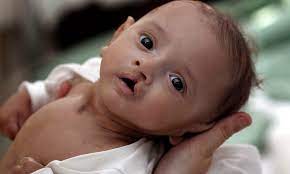 Aborted For A Cleft Palate Thousands Of Pregnancies Aborted For Abnormalities Including 500 For Down S Daily Mail Online