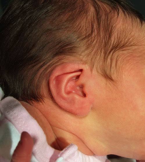 EarWell© Deformities - Pediatric Plastic Surgery Institute