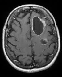 Primary brain cancer occurs when a tumor develops in the brain while metastatic, however, refers to cancer that originated elsewhere in the body and then traveled to the brain. Brain Metastases Radiology Reference Article Radiopaedia Org
