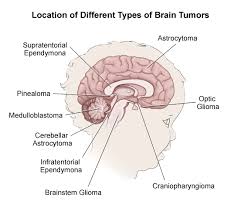 A tumour can increase the pressure inside the skull. Brain Tumors In Children Symptoms Diagnosis And Treatment