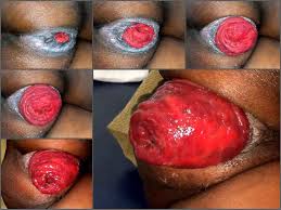 Prolapse Porn | Booty Ebony Wife Show Her Huge Anal Prolapse - Release June  24, 2017