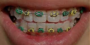 Loose brackets on your braces can have several causes from eating the wrong foods and engaging in habits like fingernail biting to loose bonding on the brackets or injury/trauma. Traditional Braces Dental Associates