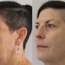 ABOUT FACE AESTHETIC CENTERS