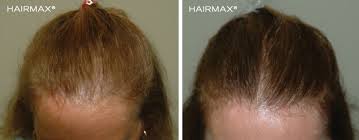 Hair loss treatment for men and women, targeted or full scalp treatment to reverse thinning hair while growing denser, fuller hair. Laser Hair Therapy Natural Hair Loss Treatment Transitions Hair
